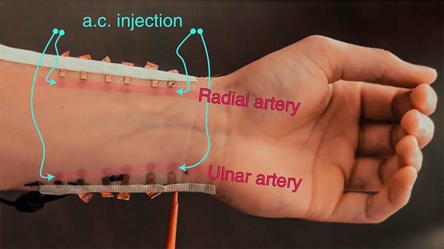 segments-of-copper-foil-are-taped-to-a-wrist-the-image-labels-identify-the-radial-and-ulnar-artery-as-well-as-spots-as-a-c-injection.jpg