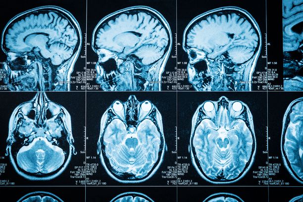 Magneettikuvissa sairastuneiden aivoista ei ole löydetty mitään epätavallista. Aivotoiminta kuitenkin rappeutuu.